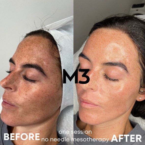 No Needle Mesotherapy